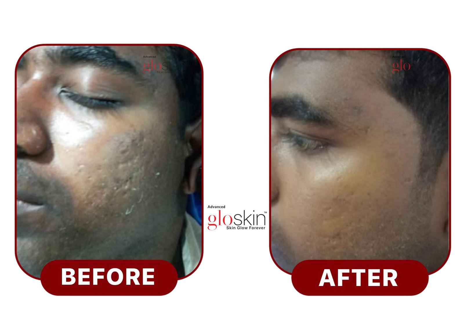 Microneedling-.jpg